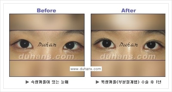 [두한성형외과 경쟁력 눈성형] - [퀵쌍꺼풀 수술 전후 정보 안내 ②] 관련 이미지 6