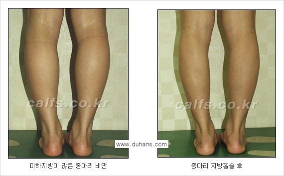 [두한성형외과 경쟁력 멀티종아리성형] - [종아리(다리) 비만 해결 방법 안내] 관련 이미지 6