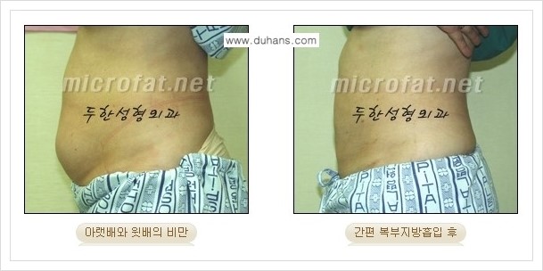 [두한성형외과 경쟁력 바디성형] - [하복부, 팔뚝, 허리선, 허벅지, 엉덩이 간편지방흡입술] 관련 이미지 17