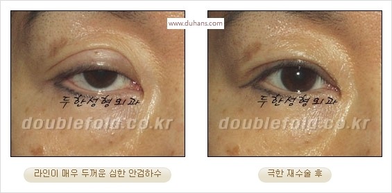 [두한성형외과 경쟁력 쌍꺼풀 재수술 스페셜] - [망가진 라인을 교정하는 극한 재수술] 관련 이미지 23