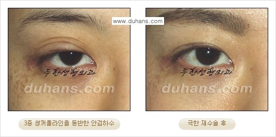 ⁠⁠⁠⁠[두한성형외과 성형 FOCUS] - [정상적인 눈매로의 복원 극한재수술 경우 ①] 관련 이미지 8