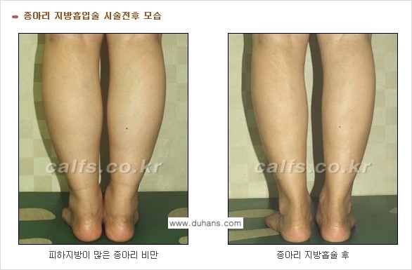 [두한성형외과 경쟁력 종아리성형] - [종아리 지방흡입 2.] 관련 이미지 3
