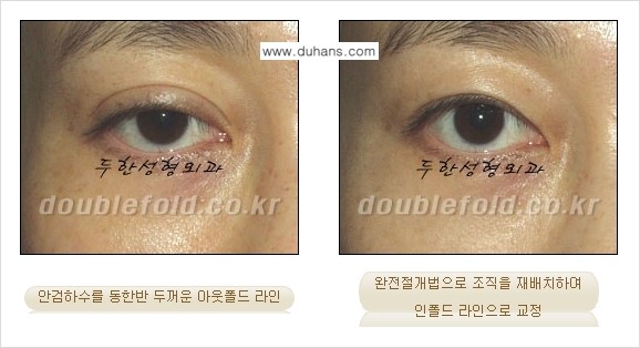 [두한성형외과] - [아웃폴드를 인폴드로 변화시키는 쌍꺼풀재수술] 관련 이미지 8