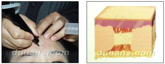 [DuHan Plastic Surgery Scar] - [DHL Simple Scar Treatment] image 6