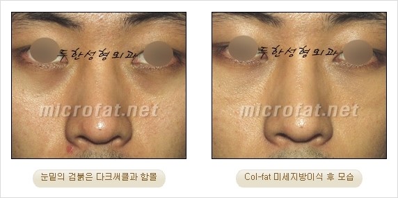 [두한성형외과 경쟁력 눈밑성형] - [Dr. 컬럼 - 눈밑 다크써클의 치료 방법과 치료 효과] 관련 이미지 3