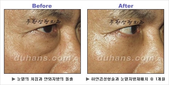 [두한성형외과 경쟁력 동안성형 리더] - ​[미간주름, 이마주름, 안검성형, 이마거상술, 눈썹거상술] 관련 이미지 113
