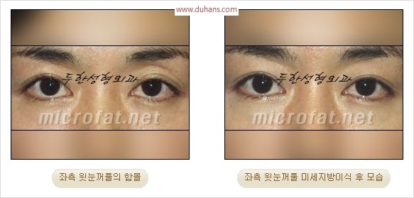 [두한성형외과 경쟁력 눈성형 리더] - [윗눈꺼풀 함몰( #꺼진눈꺼풀) 미세지방이식과 상안검성형]#꺼진눈성형 , #눈위함몰 관련 이미지 29