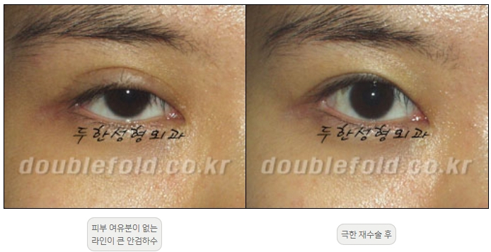 [Double Eyelid Surgery, Duhan Plastic Surgery] - [Extreme Revision Eye Surgery to Correct a Damaged Line] image 23