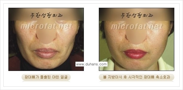 [두한성형외과 경쟁력 안면윤곽 성형] - [광대뼈 돌출, 사각턱, 야윈볼살, 역삼각형의 협소한 얼굴, 측면 볼살의 함몰선, 안면비대칭 미세지방이식] 관련 이미지 6