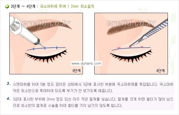[두한성형외과 성형 FOCUS] - [퀵쌍꺼풀 수술 ③] 관련 이미지 7