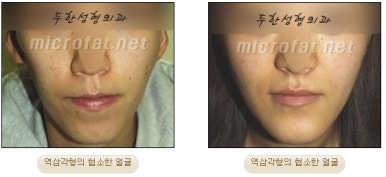 얼굴지방이식 두한성형외과 - 볼지방이식 관련 이미지 5