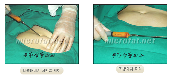 [두한성형외과 경쟁력 눈밑성형 리더] - [윗눈꺼풀 지방제거, 눈밑지방제거, 눈밑지방재배치, 눈밑지방이식 안내] 관련 이미지 16