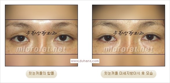 [두한성형외과 Dr. 컬럼] - [눈꺼풀의 지방이식] 관련 이미지 6