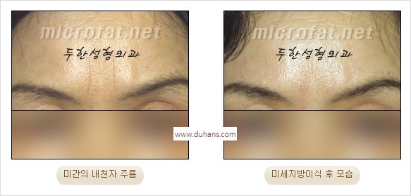 [두한성형외과 경쟁력 동안성형 리더] - ​[미간주름, 이마주름, 안검성형, 이마거상술, 눈썹거상술] 관련 이미지 18