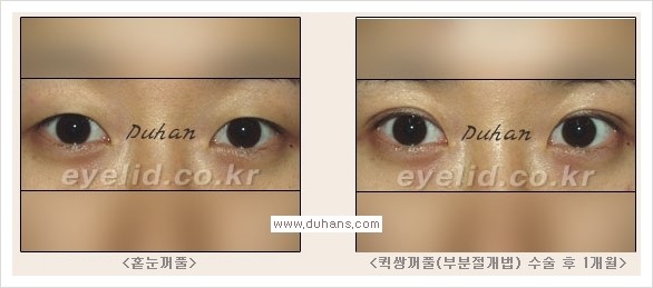 [두한성형외과 경쟁력 눈성형] - [퀵쌍꺼풀(부분절개법) 안내] 관련 이미지 1