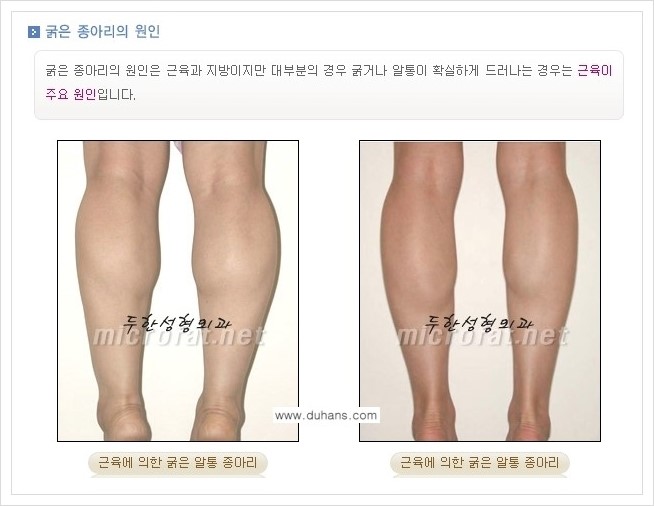 ⁠⁠⁠[두한성형외과 경쟁력 멀티종아리성형] - [굵은 알통 종아리 수술 안내 1.] 관련 이미지 3