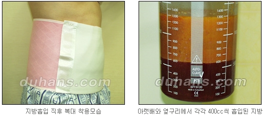 [Duhan Plastic Surgery Simple Liposuction] - [Liposuction for Obesity] image 9