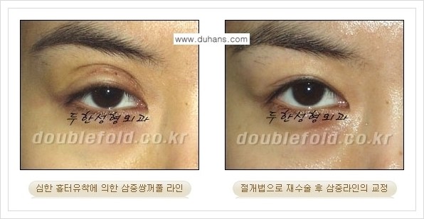 [두한성형외과 경쟁력 쌍꺼풀 재수술, 극한 재수술] - [삼중(세겹) 쌍꺼풀 라인의 교정 안내] 관련 이미지 4