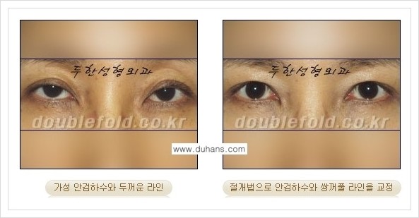 [두한성형외과 경쟁력 쌍꺼풀 재수술, 극한 재수술] - [안검하수(졸린눈매) 교정 방법 안내] 관련 이미지 9