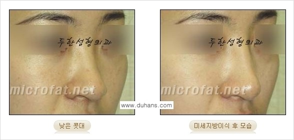 [두한성형외과 경쟁력 코성형] - [미세지방이식을 이용한 자연스러운 코성형 안내] 관련 이미지 14