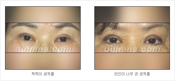 [두한성형외과 경쟁력 쌍꺼풀 재수술] - [쌍꺼풀 재수술 대상(미운쌍꺼풀)과 재수술에 필요한 검사와 테스트] 관련 이미지 1