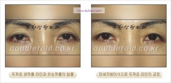 [두한성형외과 경쟁력 눈성형] - [쌍꺼풀 재수술 과정과 쌍꺼풀 재수술 실패의 원인, 쌍꺼풀 재수술의 성공 요건] 관련 이미지 32