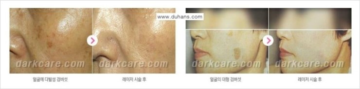 [두한성형외과 경쟁력 다크써클 치료] - [다크써클 + 검버섯 레이저 콤비 프로그램] 관련 이미지 7