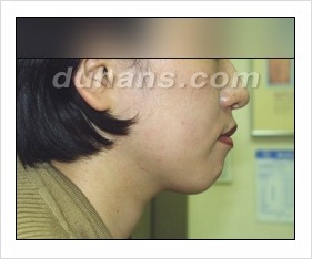 [두한성형외과 경쟁력 안면윤곽 성형 리더] - [완변한 V 라인! 턱 미세지방이식, 볼살 미세지방이식, 사각턱 보톡스 안내] 관련 이미지 50