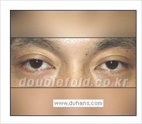 [두한성형외과 경쟁력 쌍꺼풀 재수술] - [Dr. 컬럼 - "재수술의 이상적인 목표"] 관련 이미지 6