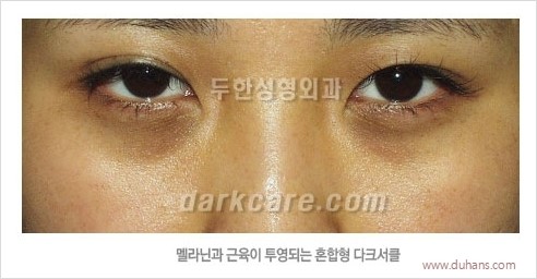[두한성형외과 경쟁력 눈밑성형] - [다크써클의 원인과 다크써클의 종류] 관련 이미지 17