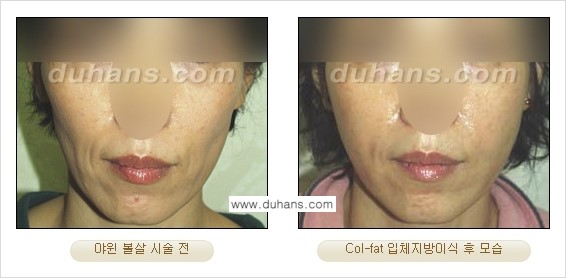 [두한성형외과 경쟁력 미세지방이식] - [탄력있는 피부와 윤곽을 만들어주는 Col-fat 지방이식] 관련 이미지 20
