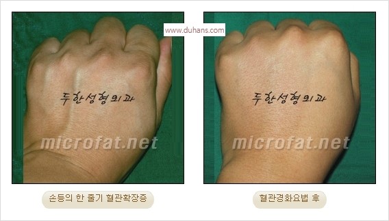 [두한성형외과 경쟁력 정맥류] - [손, 팔의 정맥확장증(혈관확장증) 치료 방법 안내] 관련 이미지 10