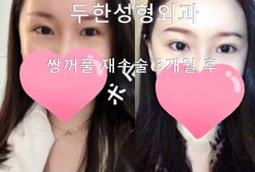 [두한성형외과] - [쌍꺼풀라인낮추기, 소세지눈재수술, 아웃라인재수술] 관련 이미지 4