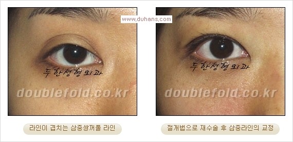 [두한성형외과 경쟁력 쌍꺼풀 재수술] - [삼중(세겹) 쌍꺼풀 라인, 눈꺼풀이 함몰된 삼중(세겹) 쌍꺼풀 라인 교정] 관련 이미지 4