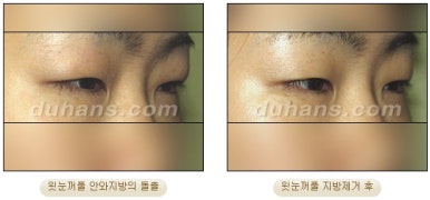 [DuHan Plastic Surgery Double Eyelid Surgery] - [Frequently Asked Questions and Answers About Eye Plastic Surgery] image 33