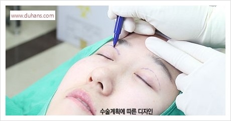 [두한성형외과 경쟁력 눈밑성형] - [다크써클 + 눈위 지방이식 콤비 프로그램] 관련 이미지 6