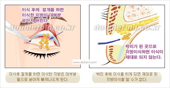 [두한성형외과 경쟁력 눈성형] - [쌍꺼풀 재수술 실패의 원인과 문제점] 관련 이미지 12