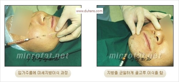 [두한성형외과 경쟁력 미세지방이식] - [3차원 다층 입체지방이식과 2차원 평면지방이식] 관련 이미지 11