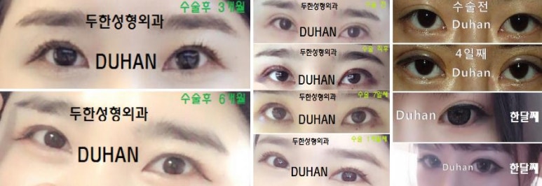 Best Place for Revision Eyelid Surgery, Duhan Plastic Surgery - Lowering Double Eyelid Line image 41