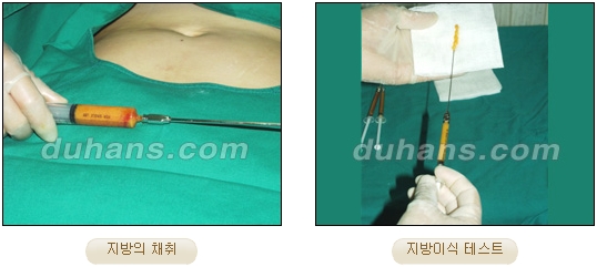 [두한성형외과 얼굴자가지방이식] - [볼살, 이마, 측두부] 관련 이미지 1