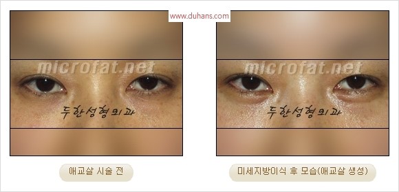 ​﻿[두한성형외과 경쟁력 지방이식] - [눈밑 애교살 시술을 위한 미세지방이식] 관련 이미지 31