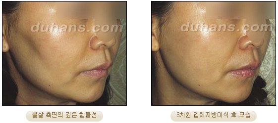 [두한성형외과 얼굴자가지방이식] - [볼살, 이마, 측두부] 관련 이미지 22