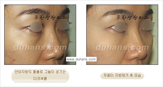 [두한성형외과 경쟁력 지방제거, 지방재배치] - [상큼하고 젊은 눈매 만들기 안내] 관련 이미지 21