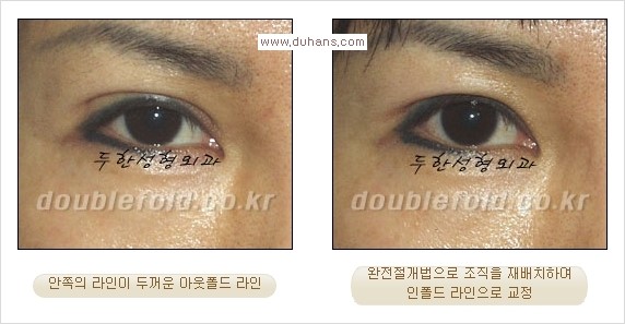 [두한성형외과 경쟁력 눈성형] - [두꺼운 아웃폴드 라인을 인폴드 라인으로 교정] 관련 이미지 8