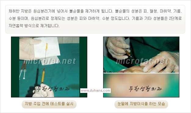 [두한성형외과 경쟁력 눈밑성형] - [눈밑이 전반적으로 함몰된 다크써클 교정 안내] 관련 이미지 3