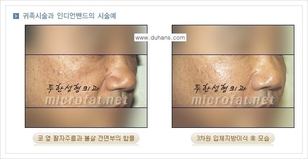 [두한성형외과 경쟁력 미세지방이식] - [귀족수술과 인디언밴드 교정 안내] 관련 이미지 6