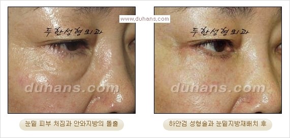 [두한성형외과 경쟁력 다크써클 교정] - [젊어 보이면서 개선된 인상을 주는 하안검 성형술] 관련 이미지 19