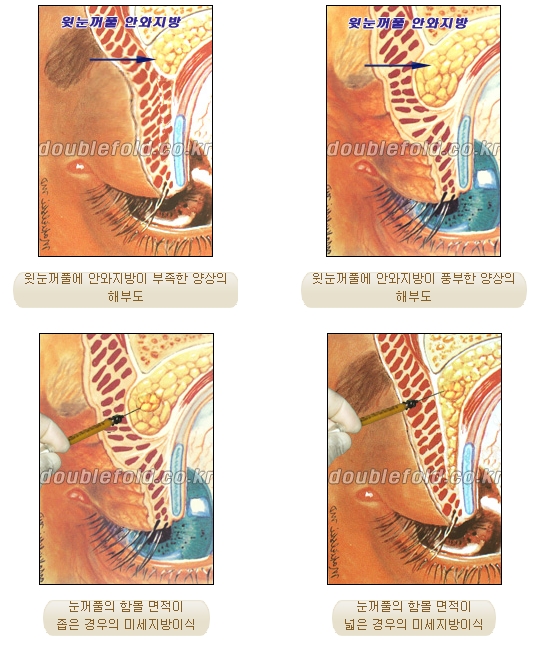 [Duhan Plastic Surgery Double Eyelid Revision Surgery] - [Correcting the Double Eyelid Line in Sunken Eyelids] image 5