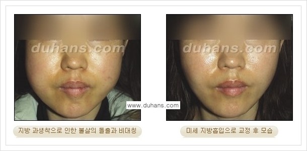[두한성형외과 경쟁력 얼굴 미세지방이식] - [타병원에서 지방이식 후 굴곡과 과주입 교정 안내] 관련 이미지 9
