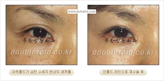 ​[두한성형외과 경쟁력 쌍꺼풀 재수술, 극한 눈재수술] - [쌍꺼풀 재수술시 지나친 아웃폴드 라인, 과도한 앞트임, 피부가 모자라 토안증 발생했을 경우 문제] 관련 이미지 1